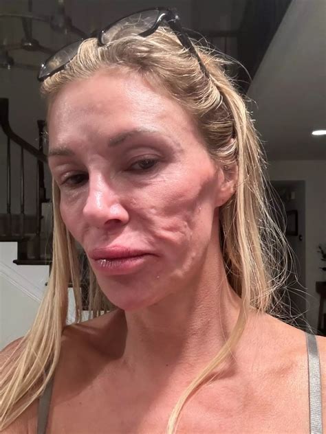 Brandi Glanville says parasite 'having babies' in face has caused her