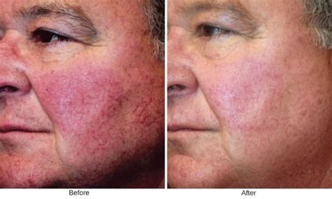BBL Photofacial in Fairfield County | Westport & New Canaan