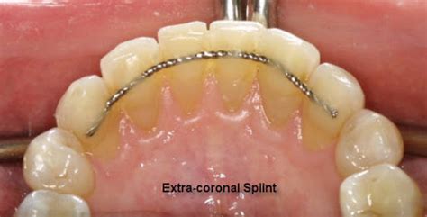 Splinting | FMS DENTAL HOSPITAL