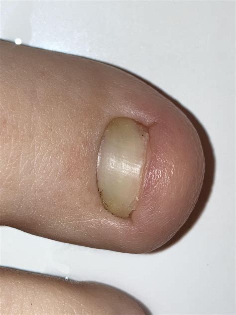Does This Look Like Something Fungal or Trauma? : r/NailFungus