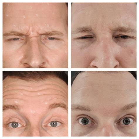 Botox & Dermal Fillers Gallery - AZ Laser Studio & Medspa