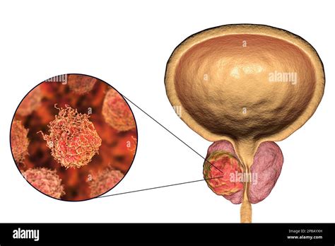 Cáncer de próstata. Ilustraciones computarizadas de un tumor canceroso ...
