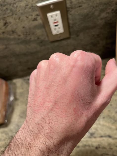 Bumps on hands after going from 30 to 60 mg : r/Accutane