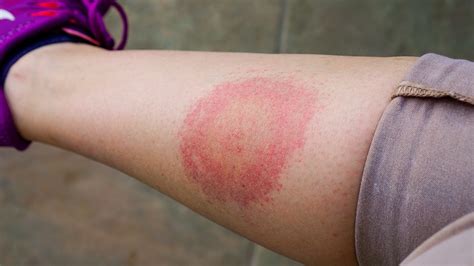 Enfermedad de Lyme: causas, síntomas, tratamiento y prevención de la ...