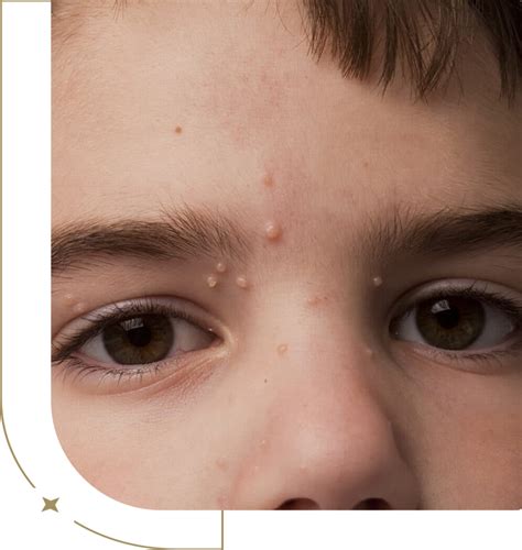 molluscum contagiosum face