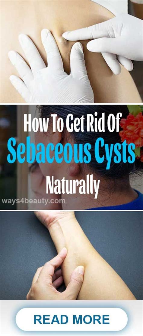 How To Get Rid Of Sebaceous Cysts Naturally – Ways For Beauty | How to ...