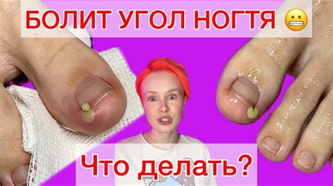 ВРОС НОГОТЬ | ЧТО ДЕЛАТЬ? | БОЛИТ УГОЛОК | ВРОСШИЙ НОГОТЬ НА НОГЕ # ...