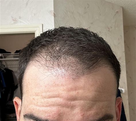 how do hair grafts work 4