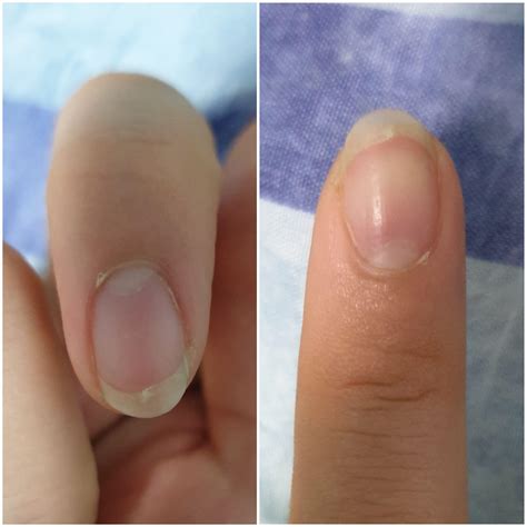 How To Fix Crooked Fingernails at Erin Patteson blog