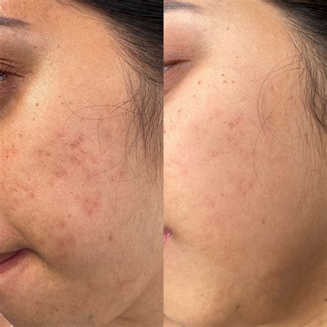 micro-needling — Orange County Lip Blush