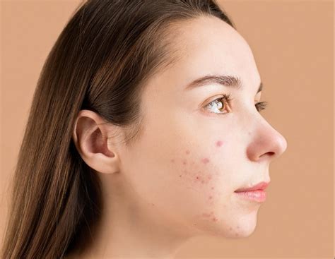 jenis jerawat penyebab  perawatannya fabella beauty clinic