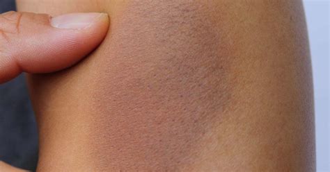Bruise colors: Causes, timescale, and when to see a doctor