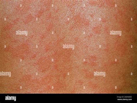 Is Pityriasis Rosea A Skin Disease at George Torres blog