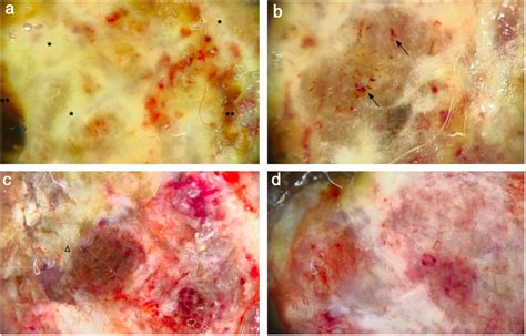 Cauliflower-like exophytic mass on the skin: polypoid melanoma ...