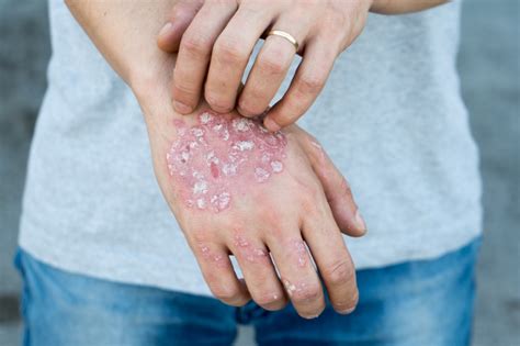 Psoriasis | Ursache | Formen | Behandlung - HEROLD