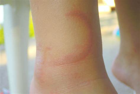 10 Home Remedies for Jellyfish Stings - eMediHealth