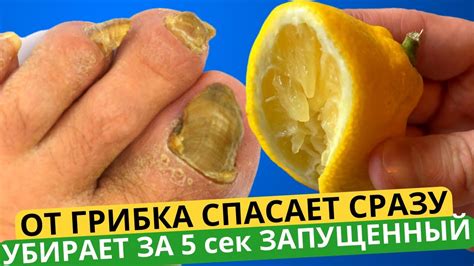 Грибок Ногтей НАВСЕГДА Исчезнет За 5 секунд, Поможет Этот Способ ...