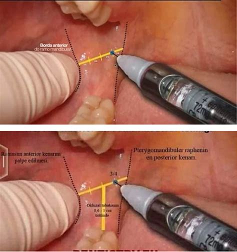 Alveolar Nerve Block at Sarah Maggie blog