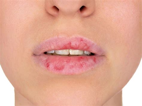 chapped lips   lipstutorialorg