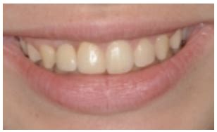 Lateral Incisor Implants With Crown Tooth 7 or 10 - South Jersey ...