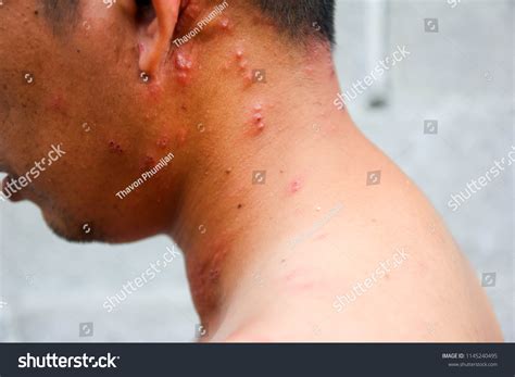 blister shingles varicella zoster virus stock photo edit
