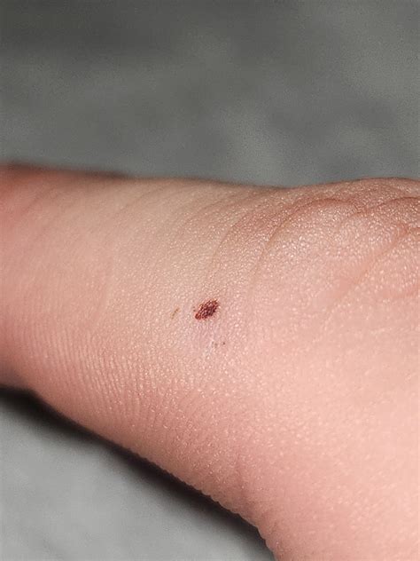 Is this acral lentiginous melanoma? : r/Dermatology