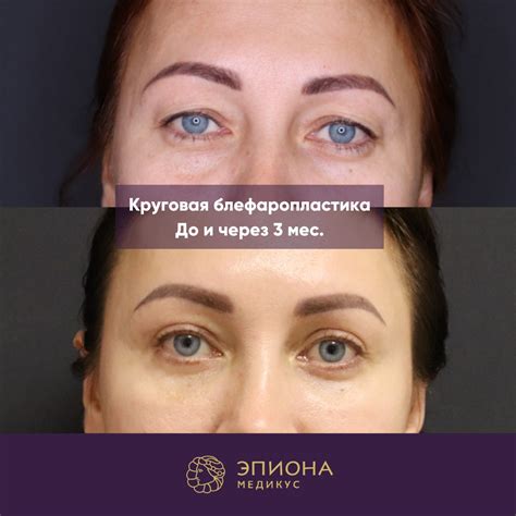 Грыжа под глазами фото причины и лечение (много фото) - artshots.ru