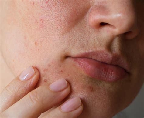perioral dermatitis home remedies 4