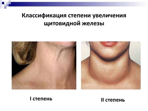 Заболевания щитовидной железы - online presentation