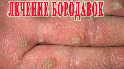 ★Как избавиться от БОРОДАВОК НА РУКАХ. Причины. Методы Лечения ...