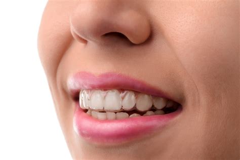 invisalign-braces-example | Aura Orthodontics