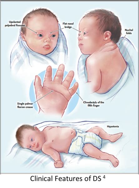 syndrome trisomy  genetics   impact  covid