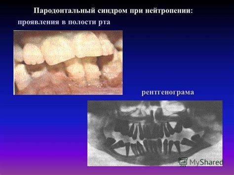 Пародонтомы. Идиопатический (наследственный) фиброматоз десен ...