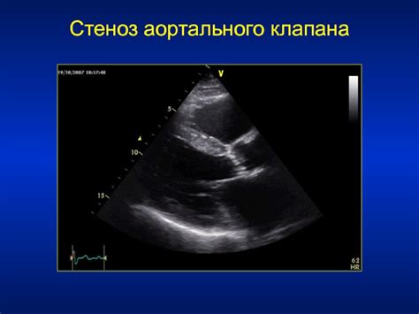 Аортальный клапан презентация, доклад