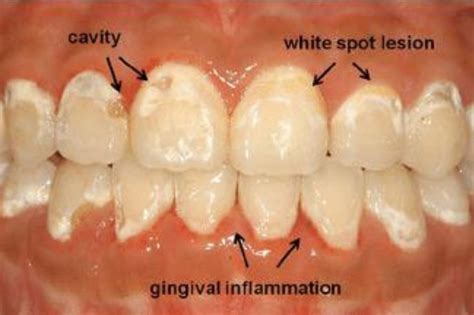 Demineralization - Lonestar Dental