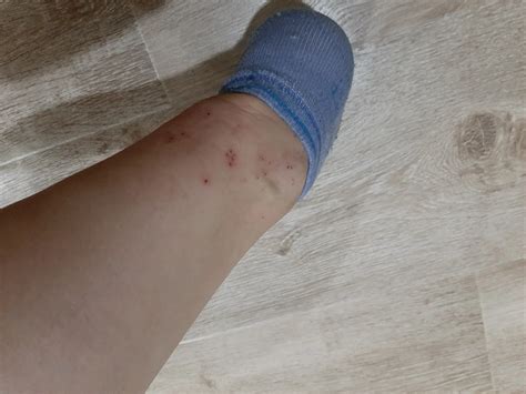 Сыпь в паху Примерно 4 года назад на ноге, ближе к паховой области , у ...