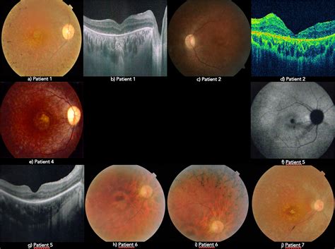 rp eye disease understanding symptoms  support