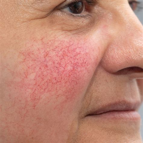 Rosacea Treatments in Kansas City | Aestheticare Medspa AesthetiCare