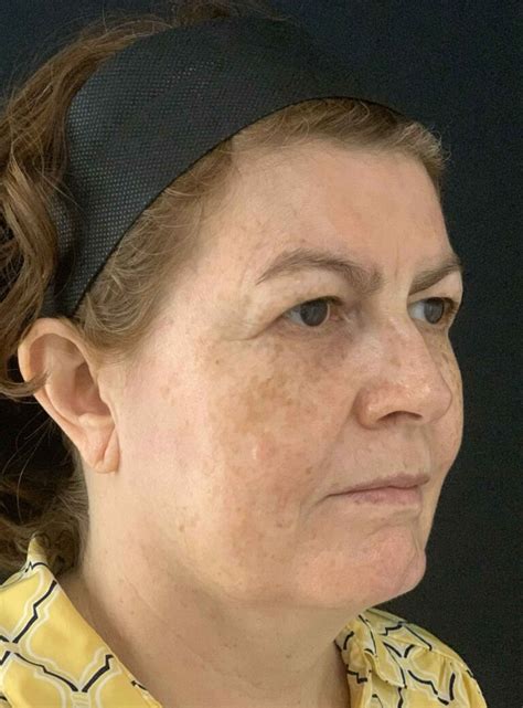 plasma laser arcose biomedical center