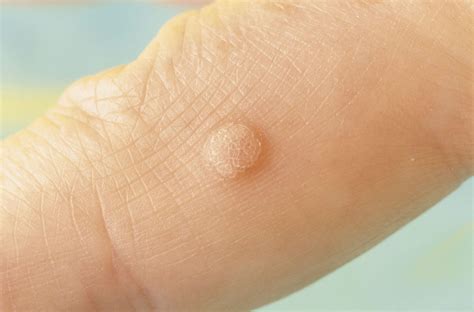 Gross Skin Conditions