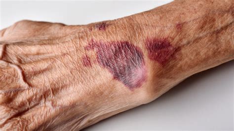 elderly abuse bruises