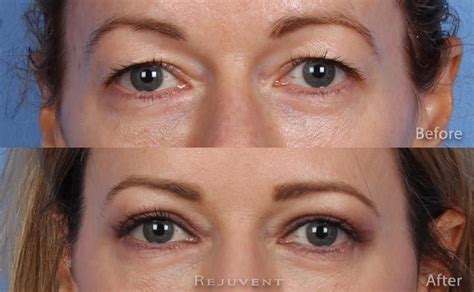 Hooded Eyelids Botox Before And After