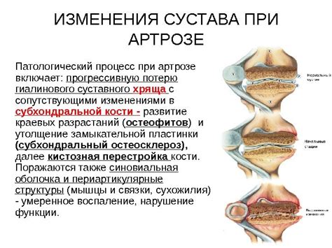 Остеоартроз. АРТРОЗ • Остеоартроз (ОА) представляет