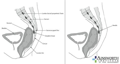 Ganglion of Impar Block - Ainsworth Institute