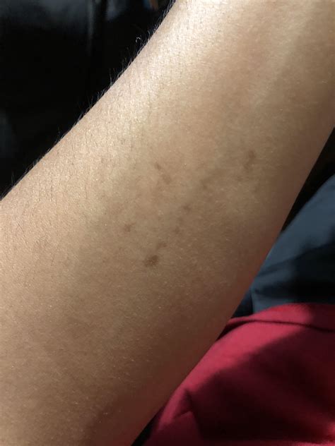 White Spots On Arm When Tan at Tawana Tibbs blog
