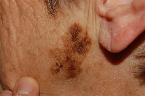 Skin Cancer Discoloration