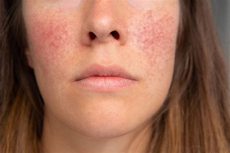 Identifying Mild Rosacea and Seeking Treatment - SL Aesthetic Clinic