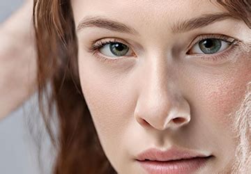Atopijski dermatitis: izvor, posledice, zdravljenje | BIO hrana