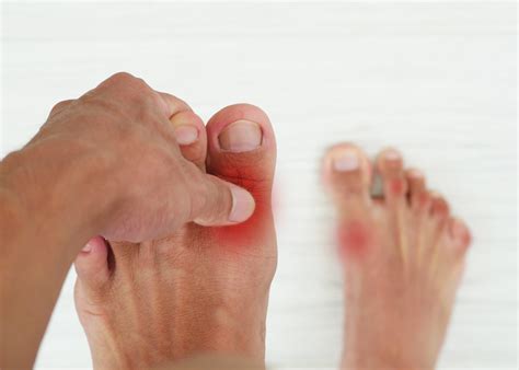 What is Gout? | Symptoms, Causes & Treatment Options