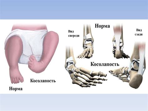 Врожденная косолапость - презентация онлайн